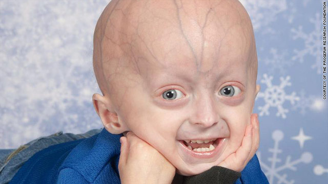 Nadir (Yetim) Hastalıklar Bölüm 3: Progeria Hastalığı