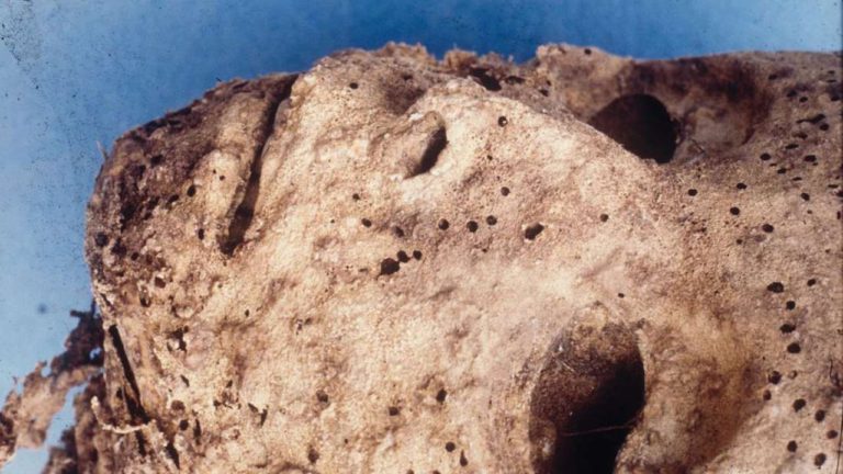 450 Yıllık Mumya, Modern Bir Hastalığın En Eski Örneğini Temsil Ediyor