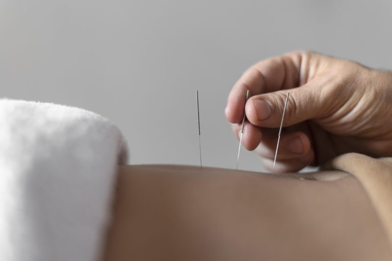 close up hand holding acupuncture needle scaled